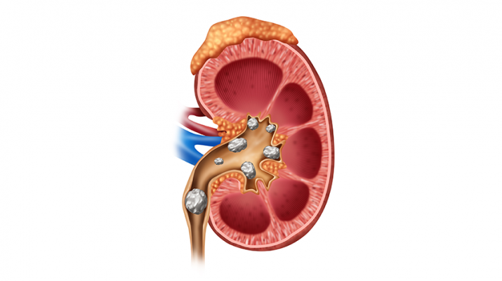 Kidney stone