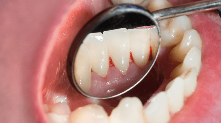 One of the signs of gingivitis is bleeding in the gum tissue. “It’s a painless disease,” said Liverpool dentist Ann Marie Adornato. “If you see any bleeding when brushing or flossing, that’s an indication that gingivitis could be occurring.”