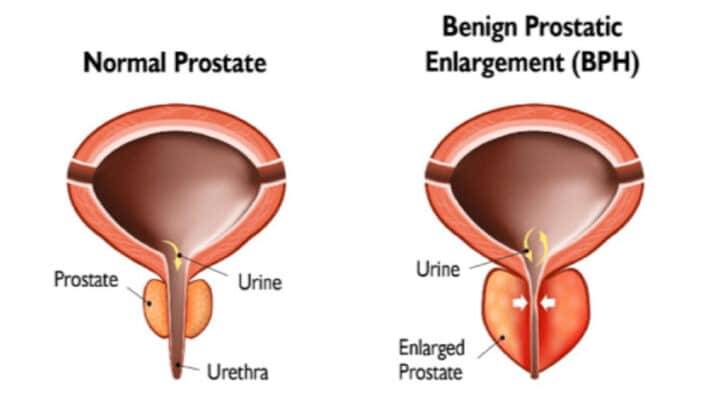 Figure 1: Benign prostatic enlargement