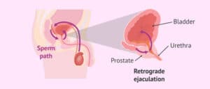 Figure 2: Retrograde ejaculation