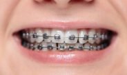 ‘Never Been Cooler’: Metal Braces Making Comeback