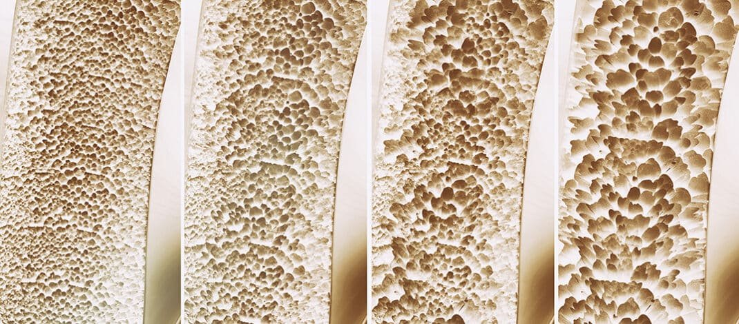 Medication Can Raise Osteoporosis Risk