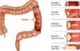 Colon Cancer Now Top Cancer Killer for People Under 50