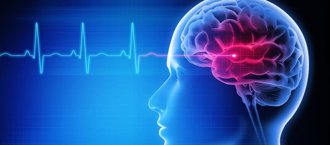 Stroke Recovery Tips